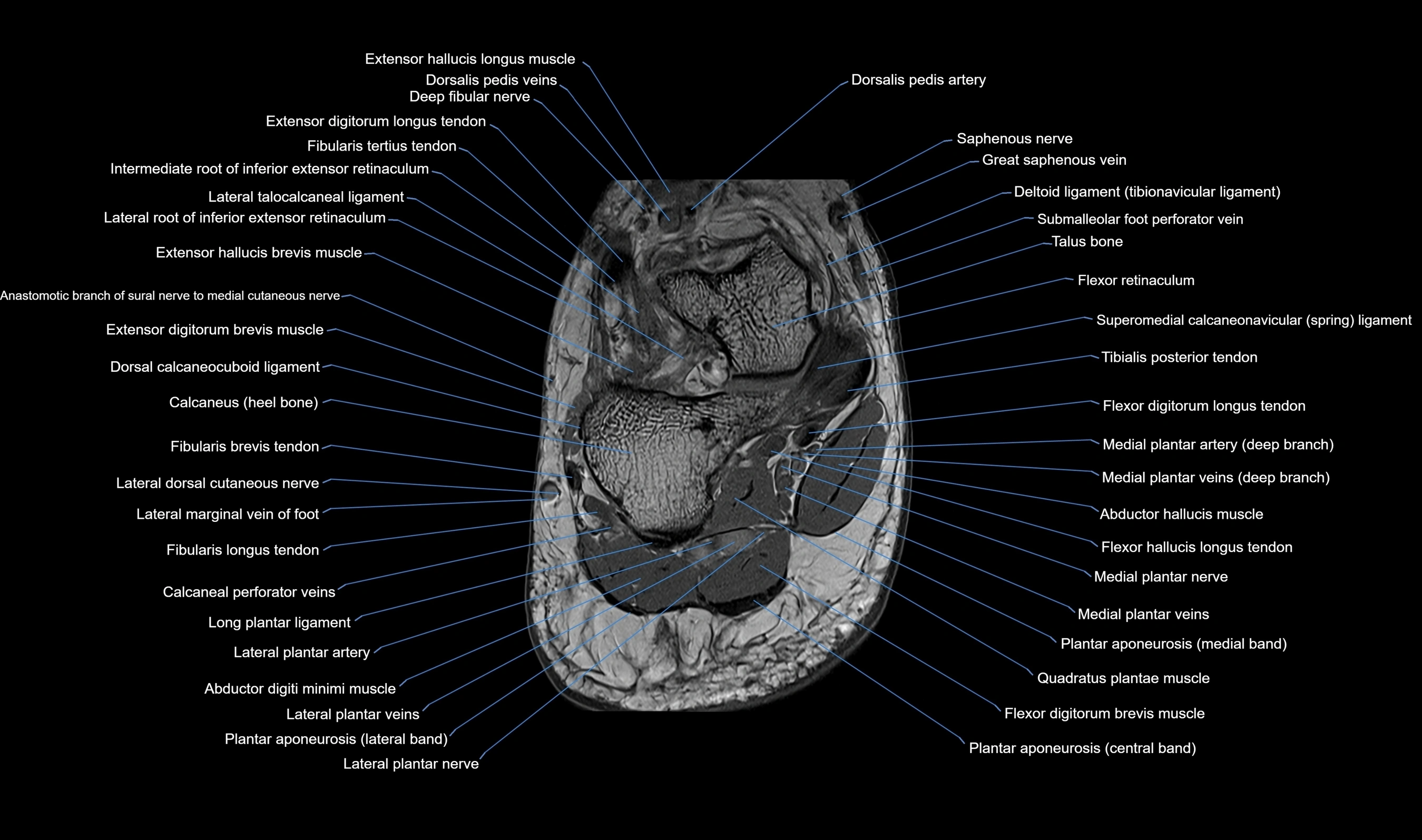 MRI mid foot axial cross sectional anatomy 3T  radiology  image-img-00001-00041.webp
